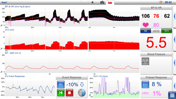 LiDCOunity | LiDCO – Hemodynamic Monitoring for the entire patient pathway
